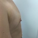 Breast Augmentation Before & After Patient #6132