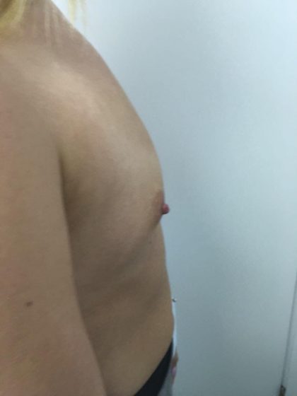 Breast Augmentation Before & After Patient #6132