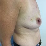 Breast Reconstruction Before & After Patient #6185