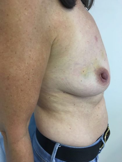 Breast Reconstruction Before & After Patient #6185