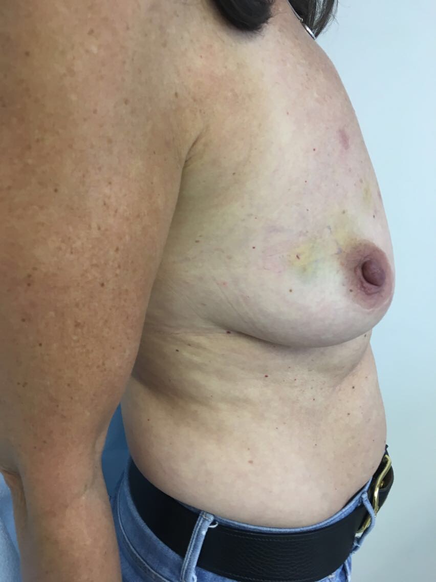 Breast Reconstruction Before & After Patient #6185