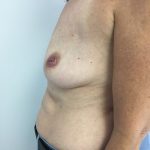 Breast Reconstruction Before & After Patient #6185