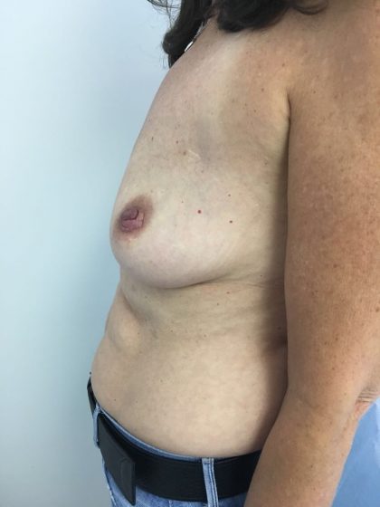 Breast Reconstruction Before & After Patient #6185