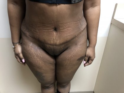 Tummy Tuck Before & After Patient #6290