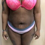 Tummy Tuck Before & After Patient #6290