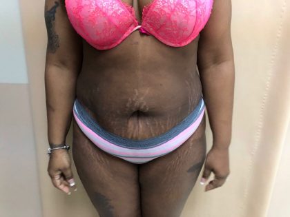 Tummy Tuck Before & After Patient #6290