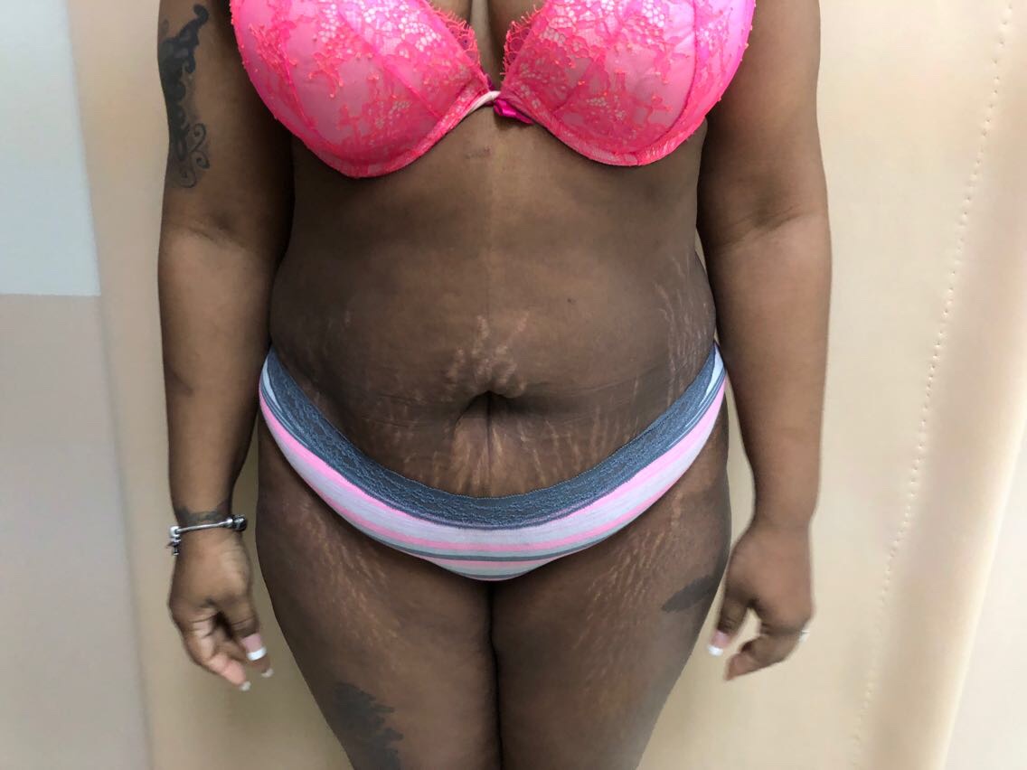 Tummy Tuck Before & After Patient #6290
