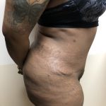 Tummy Tuck Before & After Patient #6290