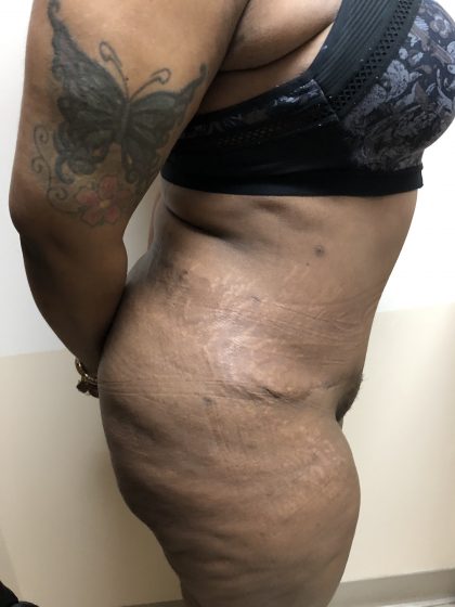 Tummy Tuck Before & After Patient #6290