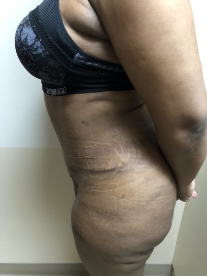 Tummy Tuck Before & After Patient #6290