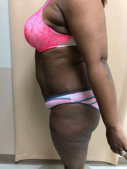 Tummy Tuck Before & After Patient #6290