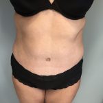 Tummy Tuck Before & After Patient #6253