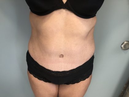 Tummy Tuck Before & After Patient #6253