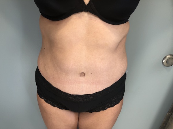 Tummy Tuck Before & After Patient #6253