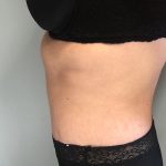 Tummy Tuck Before & After Patient #6253