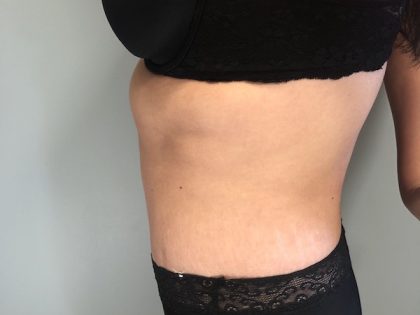 Tummy Tuck Before & After Patient #6253