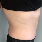 Tummy Tuck Before & After Patient #6253