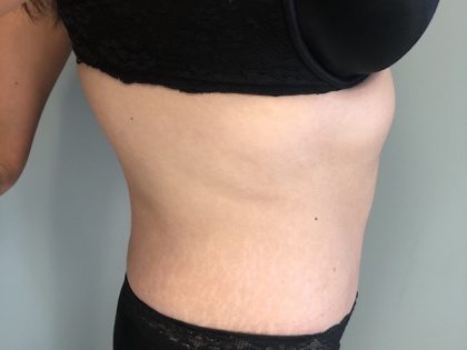 Tummy Tuck Before & After Patient #6253