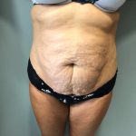 Tummy Tuck Before & After Patient #6253
