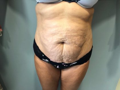 Tummy Tuck Before & After Patient #6253