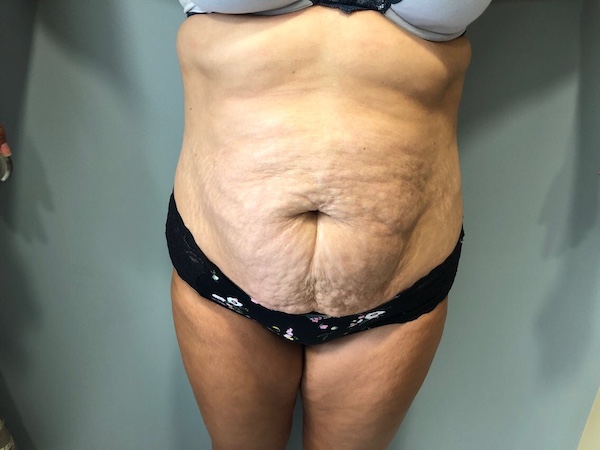 Tummy Tuck Before & After Patient #6253