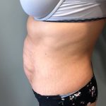 Tummy Tuck Before & After Patient #6253