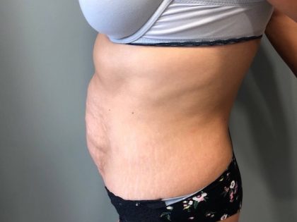 Tummy Tuck Before & After Patient #6253