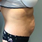 Tummy Tuck Before & After Patient #6253