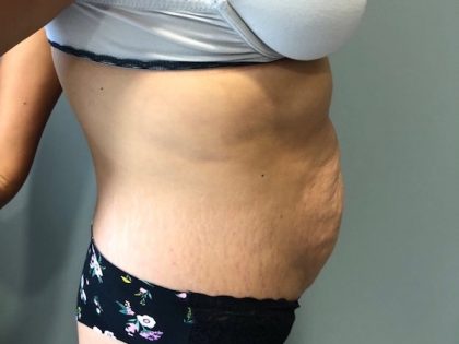 Tummy Tuck Before & After Patient #6253