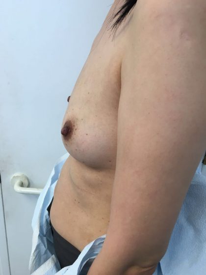 Breast Reconstruction Before & After Patient #6283