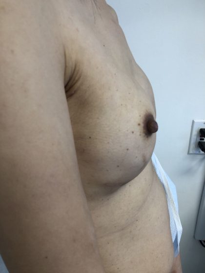 Breast Reconstruction Before & After Patient #6283