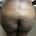 Brazilian Butt Lift Before & After Patient #6297
