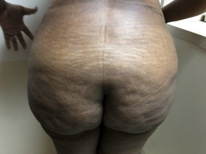 Brazilian Butt Lift Before & After Patient #6297