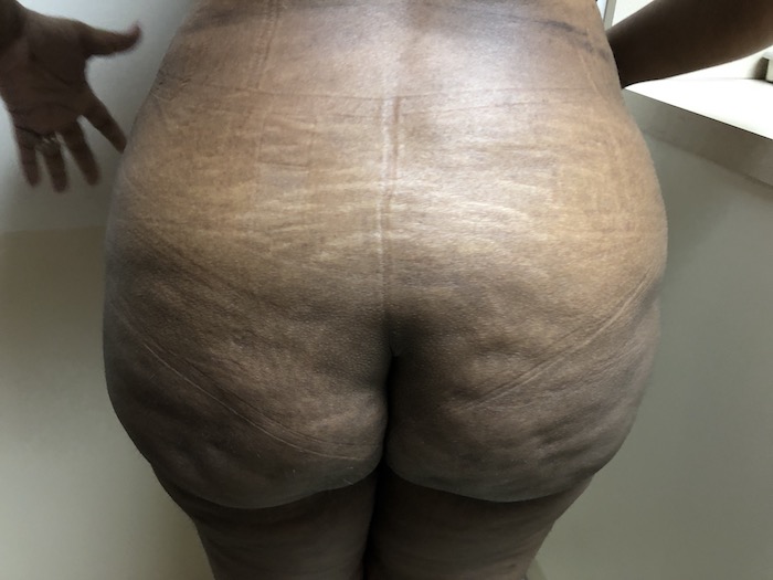 Brazilian Butt Lift Before & After Patient #6297