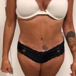 Tummy Tuck Before & After Patient #6313