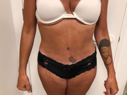 Tummy Tuck Before & After Patient #6313