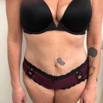 Tummy Tuck Before & After Patient #6313