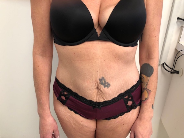 Tummy Tuck Before & After Patient #6313