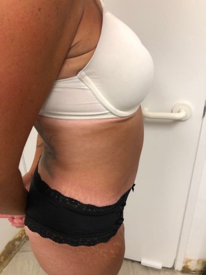 Tummy Tuck Before & After Patient #6313