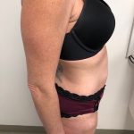 Tummy Tuck Before & After Patient #6313