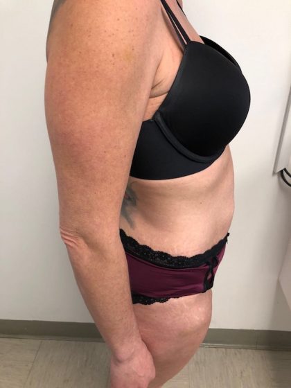 Tummy Tuck Before & After Patient #6313