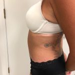 Tummy Tuck Before & After Patient #6313