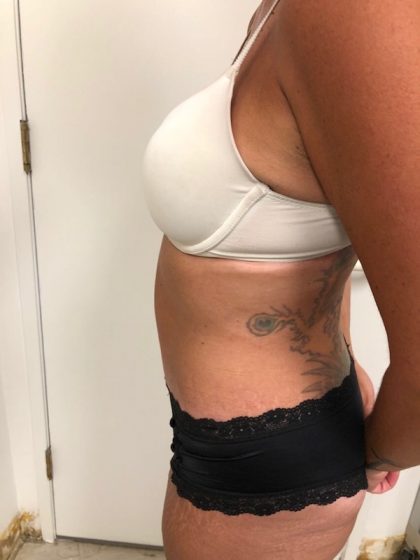 Tummy Tuck Before & After Patient #6313