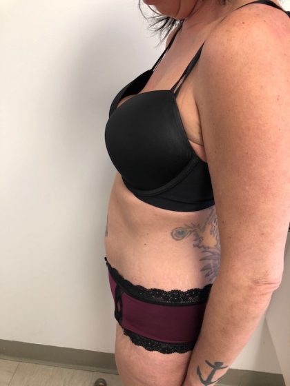 Tummy Tuck Before & After Patient #6313