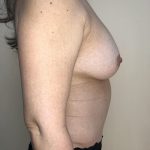 Breast Augmentation Before & After Patient #6348