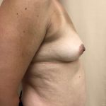 Breast Augmentation Before & After Patient #6348