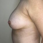 Breast Augmentation Before & After Patient #6348