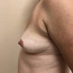 Breast Augmentation Before & After Patient #6348