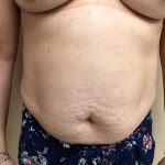 Tummy Tuck Before & After Patient #6341