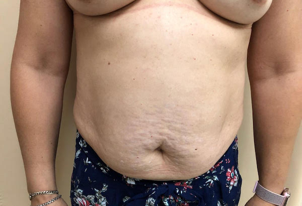 Tummy Tuck Before & After Patient #6341